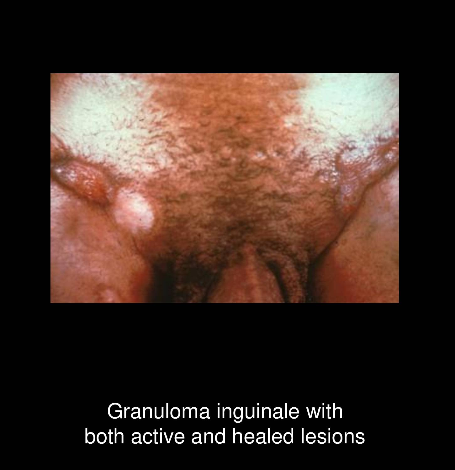 Granuloma inguinale pseudobubo showing subcutaneous inguinal nodule with overlying skin changes in donorvanosis patient at STD Nepal